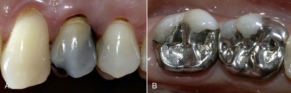 Mercury amalgam fillings are not a good dental treatment